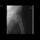 Pertrochanteric fracture, comminuted: X-ray - Plain radiograph